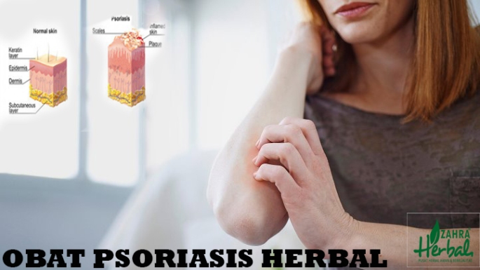Obat Psoriasis Herbal